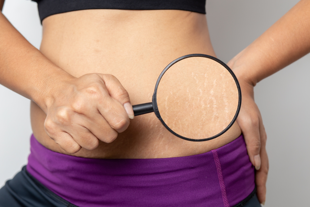 How to Combat Stretch Marks