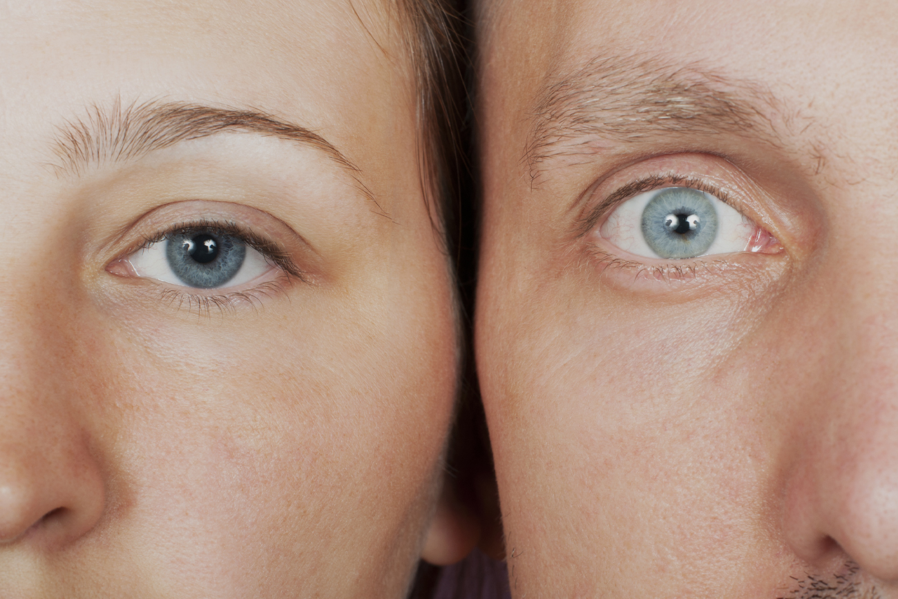 Blepharoplasty without surgery